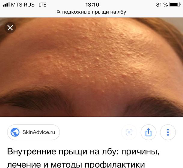 Прыщи на лбу