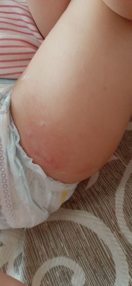 Как думаете это укусы?