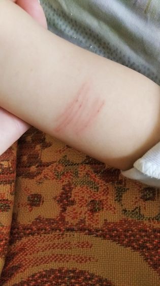 Реакция на новокаин. Аллергия или нет?
