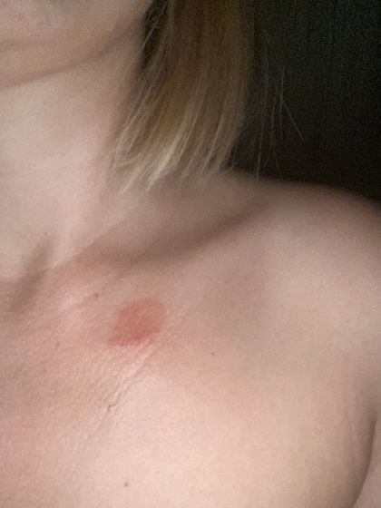 Розовый лишай?????