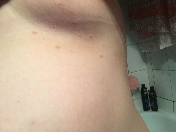 Пятна!!!! Чем спасаться ? Что может быть ? 🆘🆘🆘🆘🆘🆘