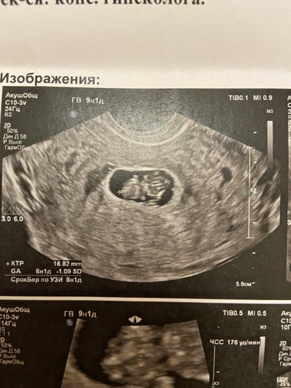 Узи 9 недель