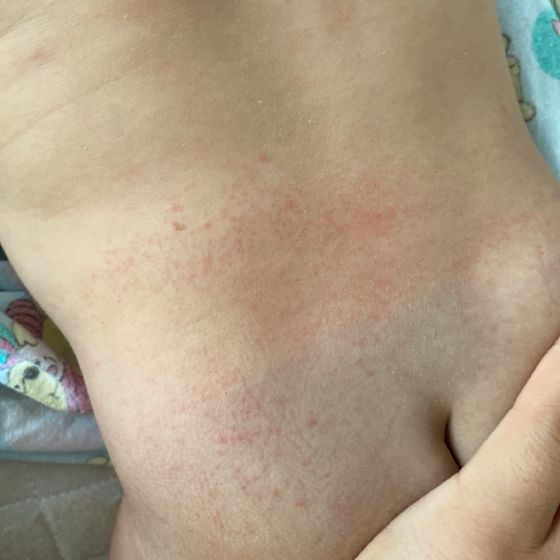 Девочки это аллергия?