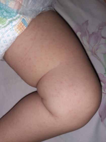 Помогите понять что это за сыпь??!!!