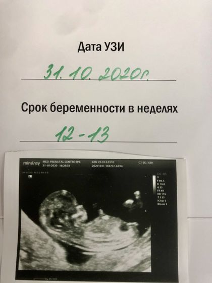 Пол в 12-13 недель на скрининге