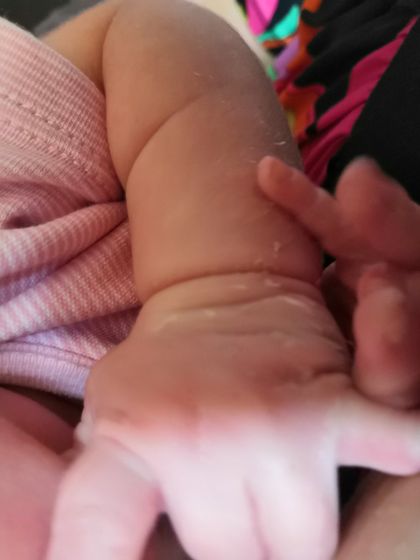 Шелушится и облезает кожа у новорожденного