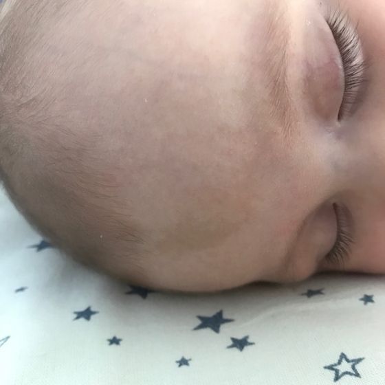 Родимое пятно на лобике