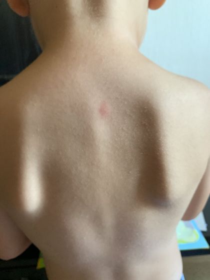 Это потница?(красное пятно это укус)