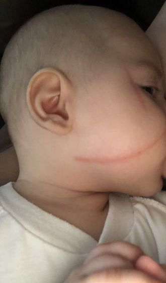 Чем помазать царапину на лице ребёнку