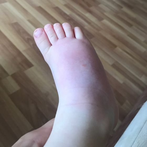 Опухла ножка от укуса