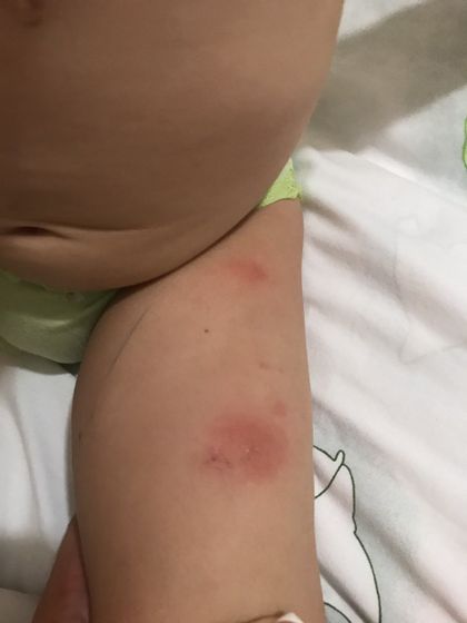 Помогите , покушали комары