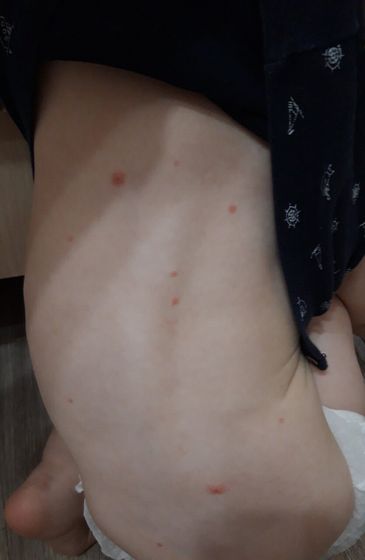 Сыпь на прививку ККП