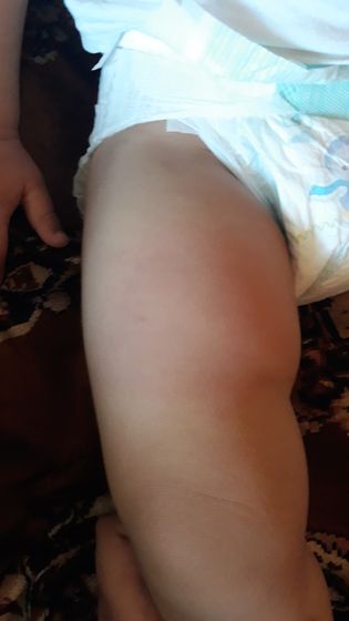 Сделали всера прививку. Сегодня опухло вокруг укола