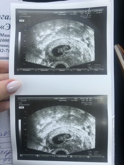 Моя любовь! ❤️ узи, 8.3 недели