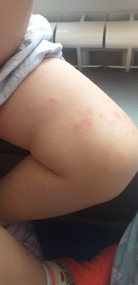 Сыпь у ребенка по