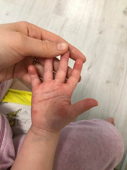 Мамы аллергичных деток, зайдите пож ((