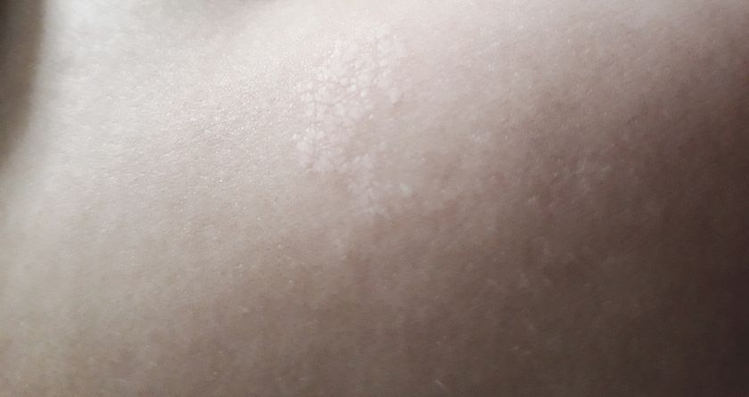 Родимое Пятно?