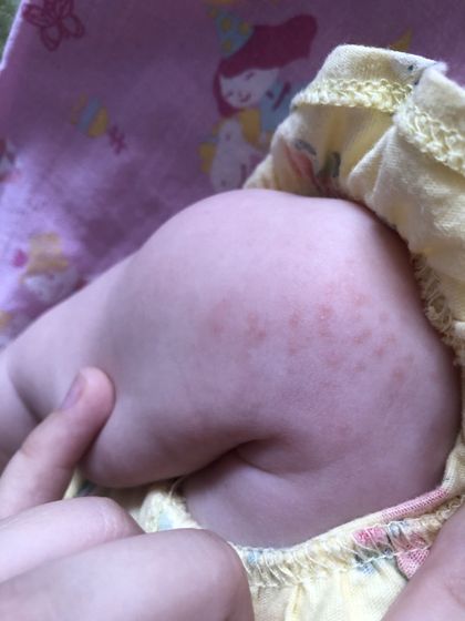 Сыпь у ребенка