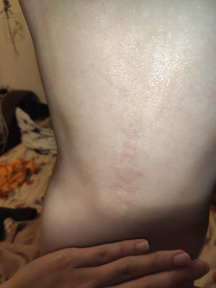 Аллергия?