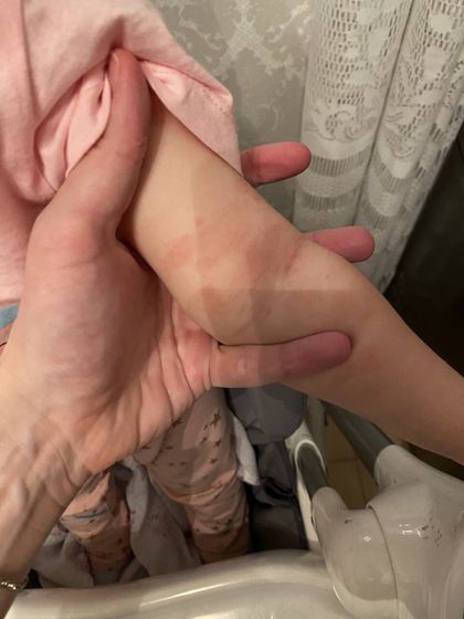 Аллергия!