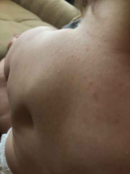 Потничка или аллергия ?