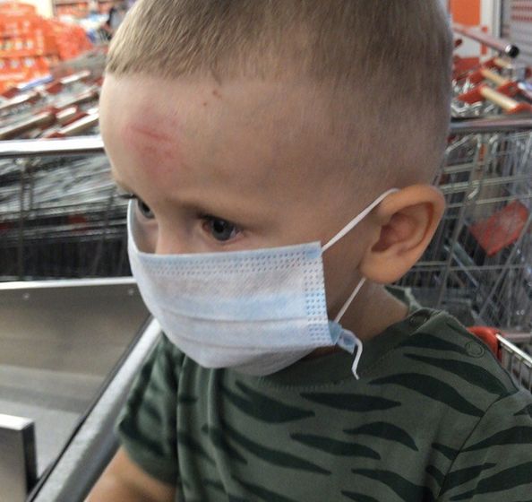 Чем мазать ссадину и шишку на лбу