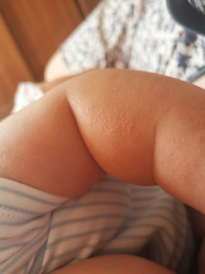 Не пойму аллергия или нет?