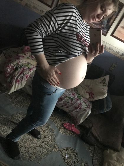 Опущение живота