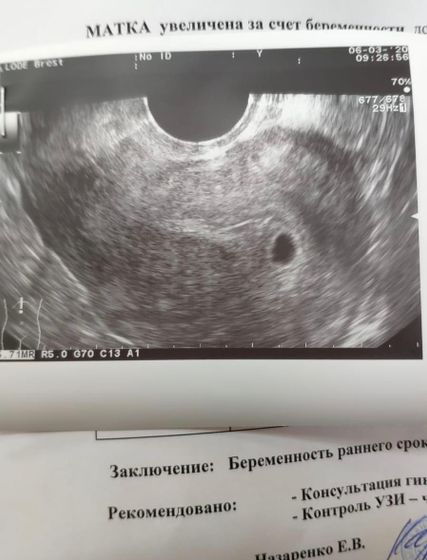 21ДПП, УЗИ, плодное яйцо??? Эко