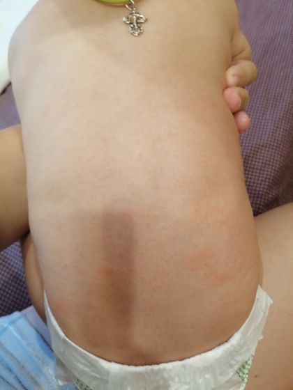 Подскажите это аллергия или
