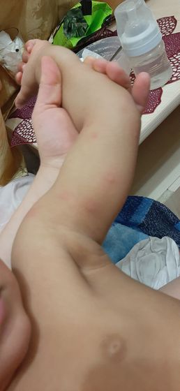 Пятна-шишки ввиде укуса комара у ребенка - это аллергия? (Фото)