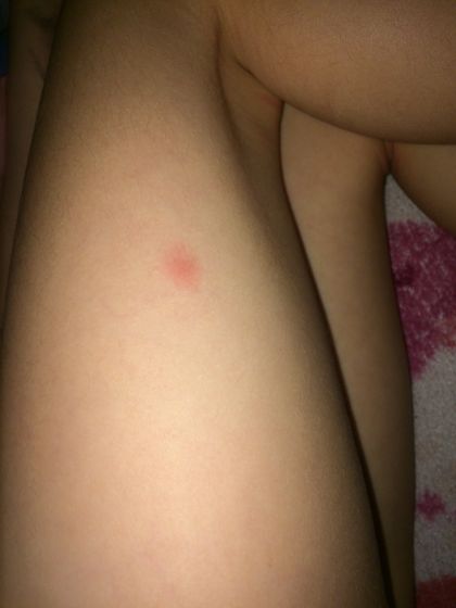 Сыпь
