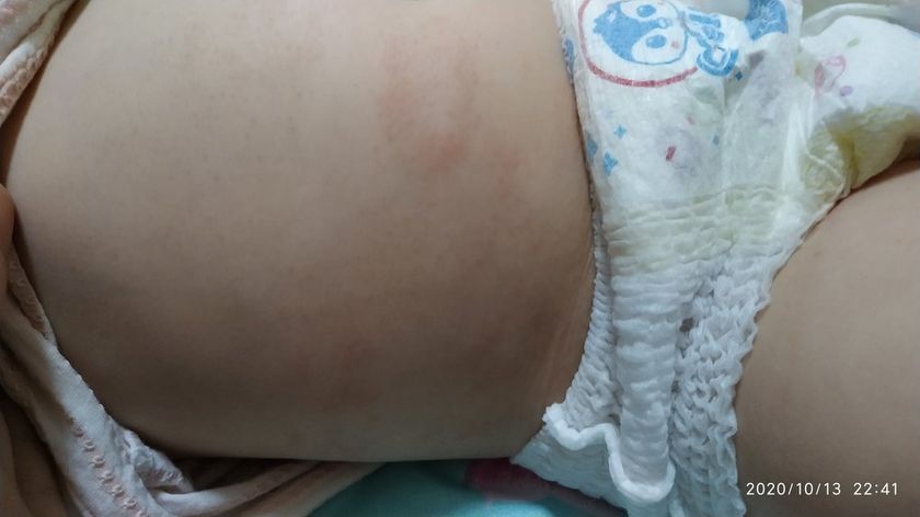 Дочку опять начало сыпать