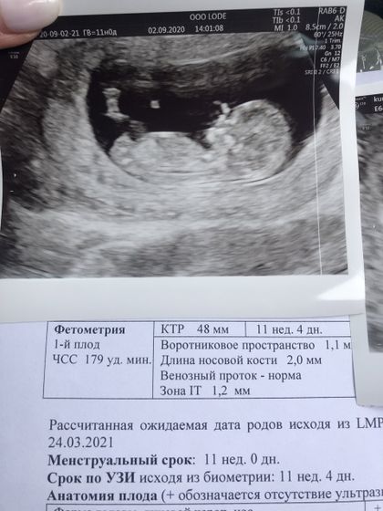 Узи 11 недель ?