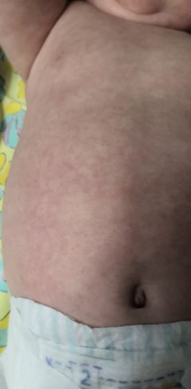 Аллергия или потница?
