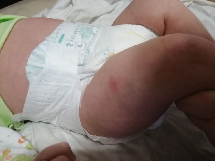 Превенар Сделали вчера прививку