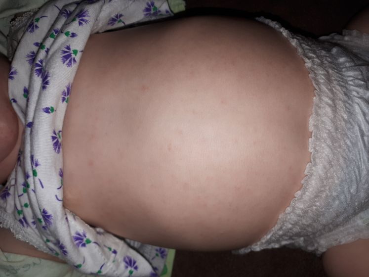 Аллергия или потничка?