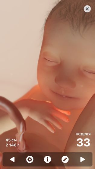 3 скрининг Гиперэхогенное расширение кишечника до 10 мм.
