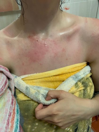 Аллергия на солнце