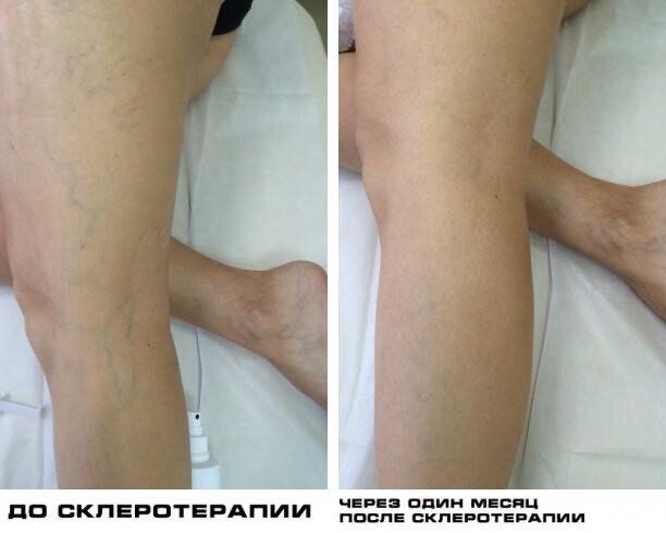 Склеротерапия нижних вен