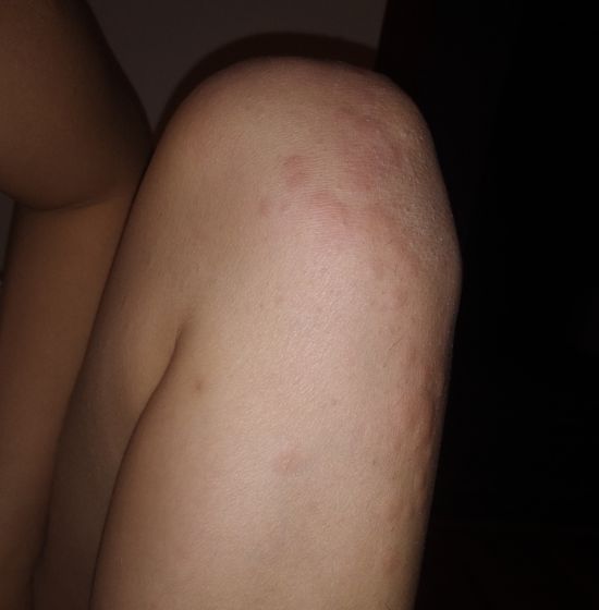 Обсыпало логти и колени,