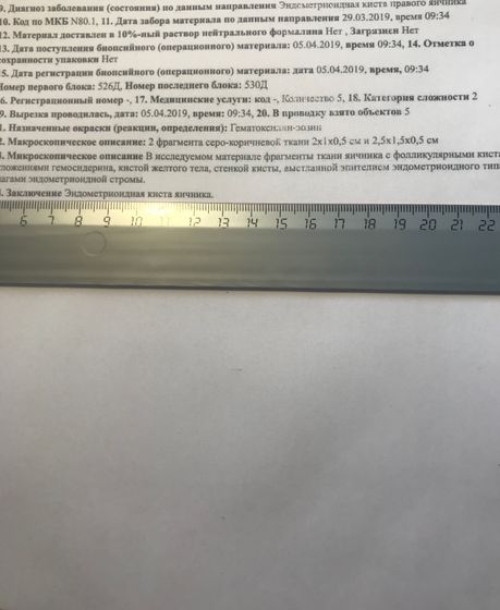Биопсия эндометриоидной кисты после лапароскопии