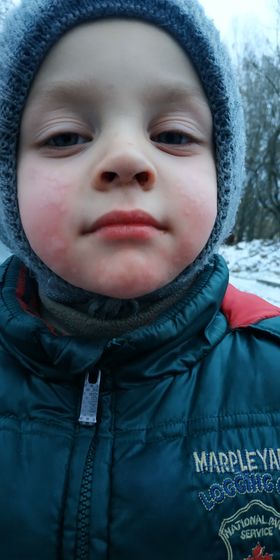 Холодовая аллергия.