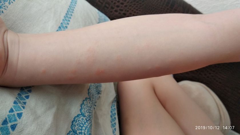 Аллергическая сыпь??