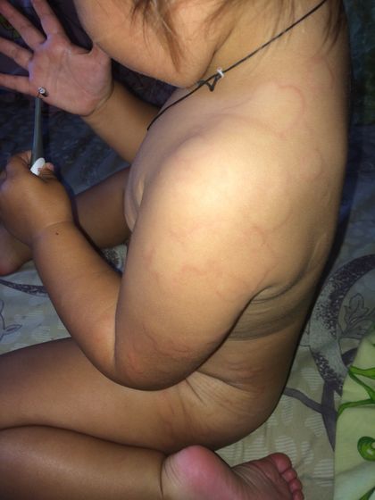 SOS!!! Крапивница!!!!
