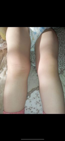 Ушиб? Артрит? Срочно подскажите😭😭😭🥴