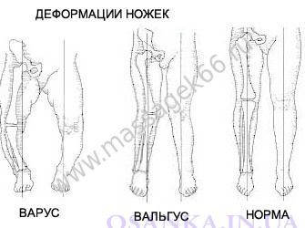 Варусная деформация стопы