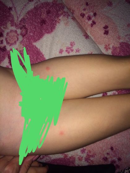 Сыпь
