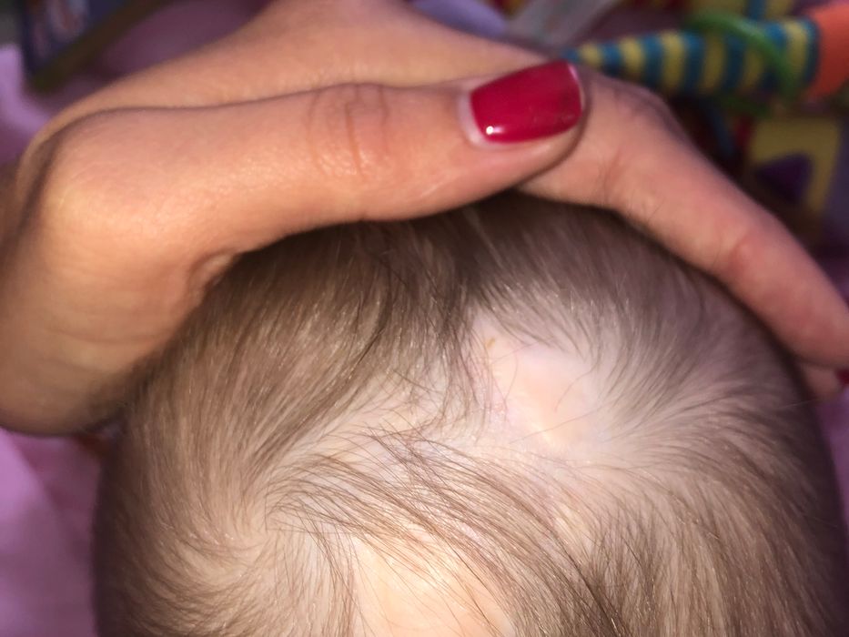 Повреждение кожных покровов головы ребёнка при прокалывании плодного пузыря